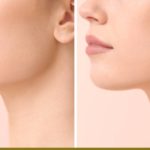 chin augmentation, rowe plastic surgery