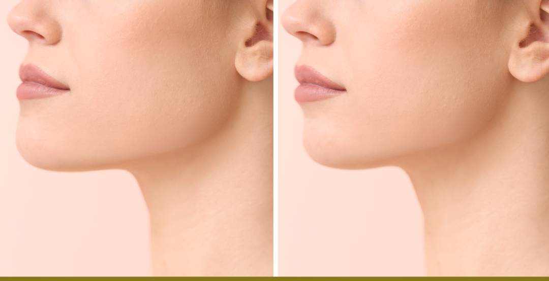 chin augmentation, rowe plastic surgery