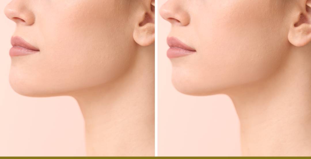 chin augmentation, rowe plastic surgery