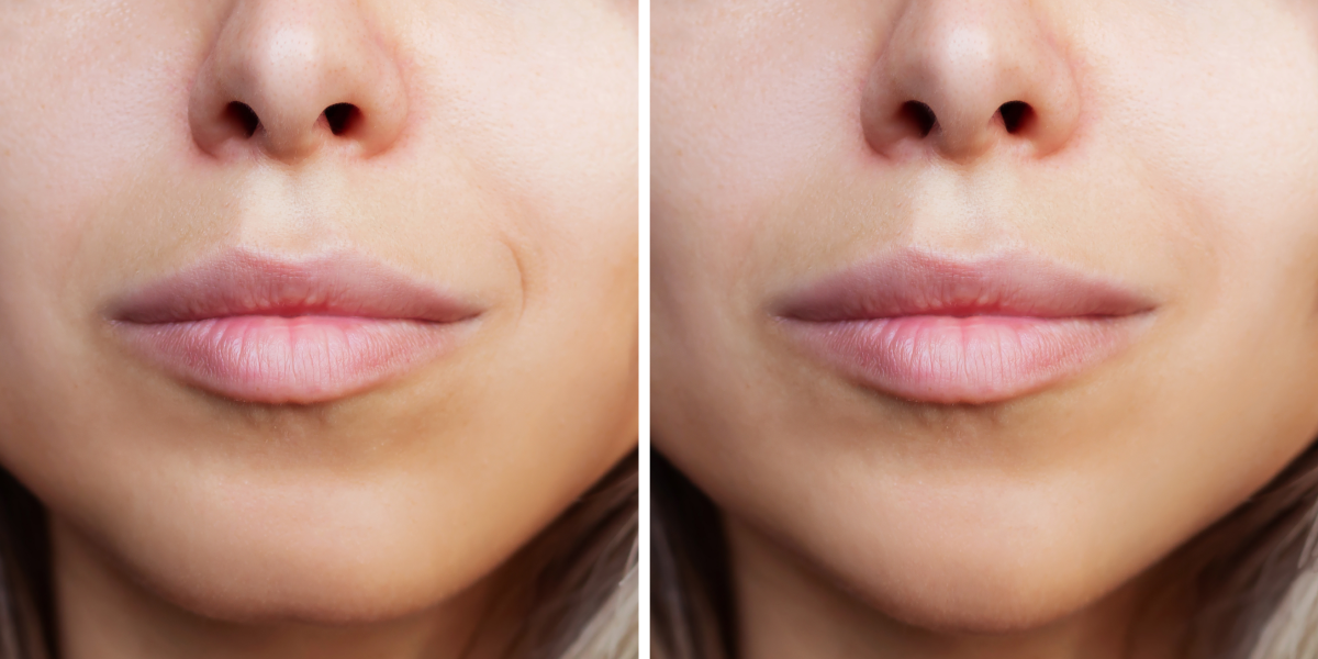 chin augmentation